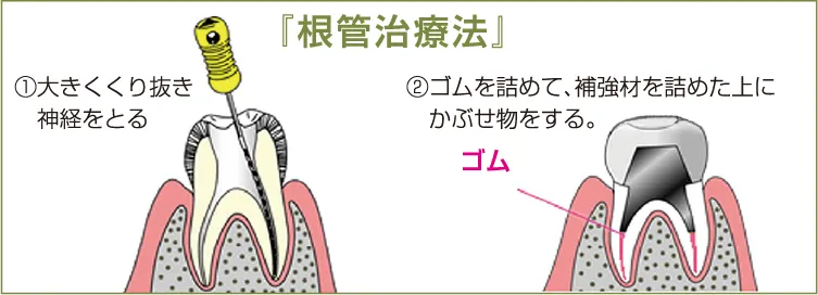 抗菌性根充法