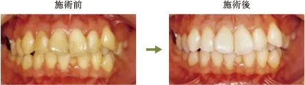 ホワイトニングbeforeafter