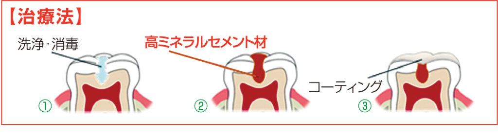 虫歯治療方法