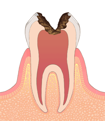 歯髄まで達した虫歯