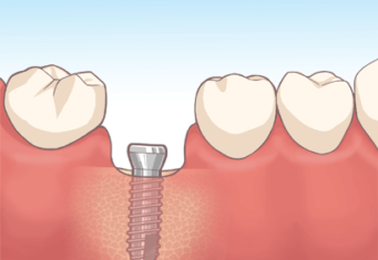 インプラント埋入