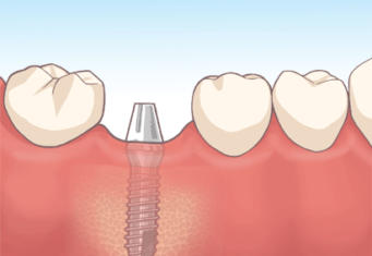 インプラント定着期間