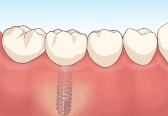 インプラント人工歯セット